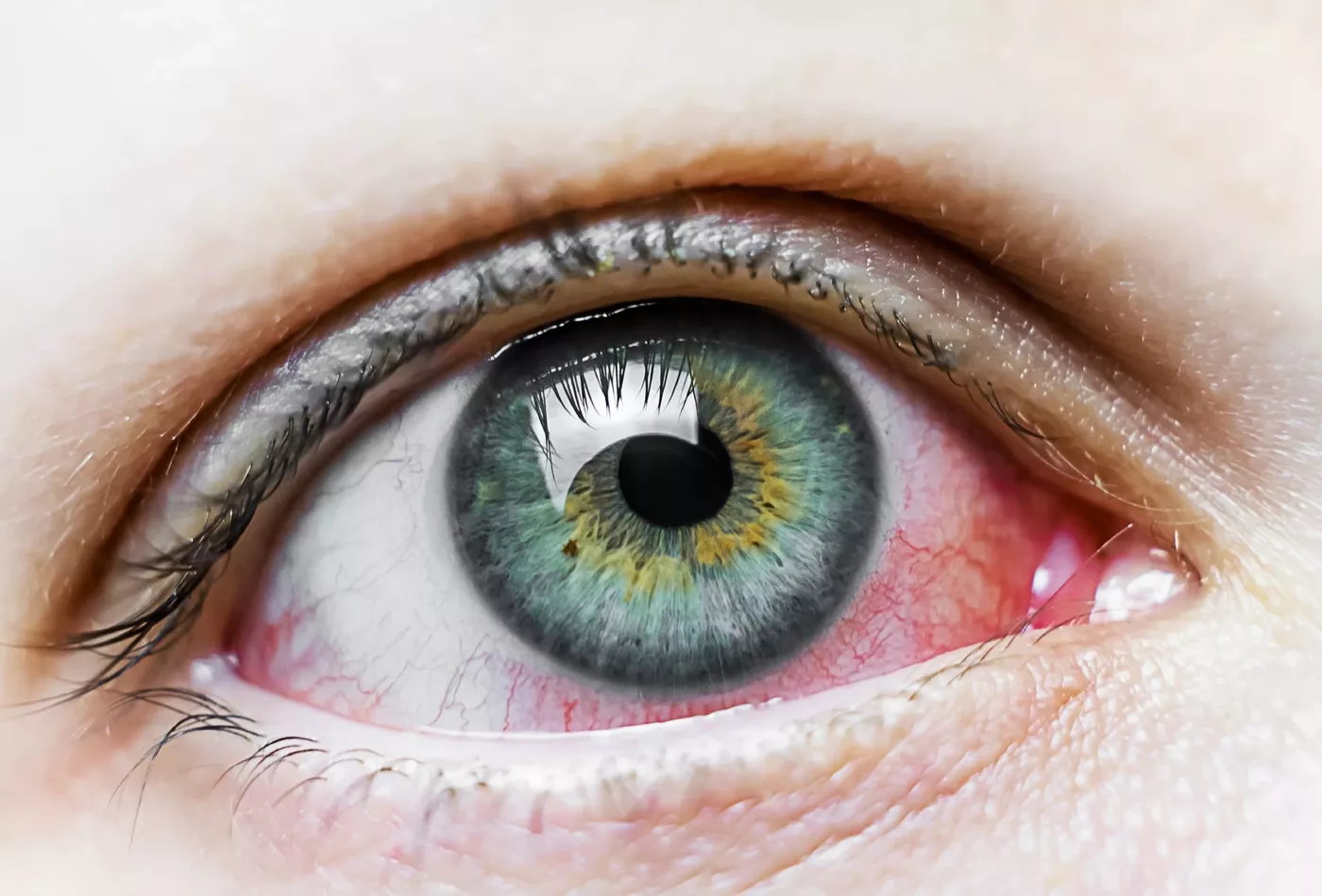 Conjuntivitis