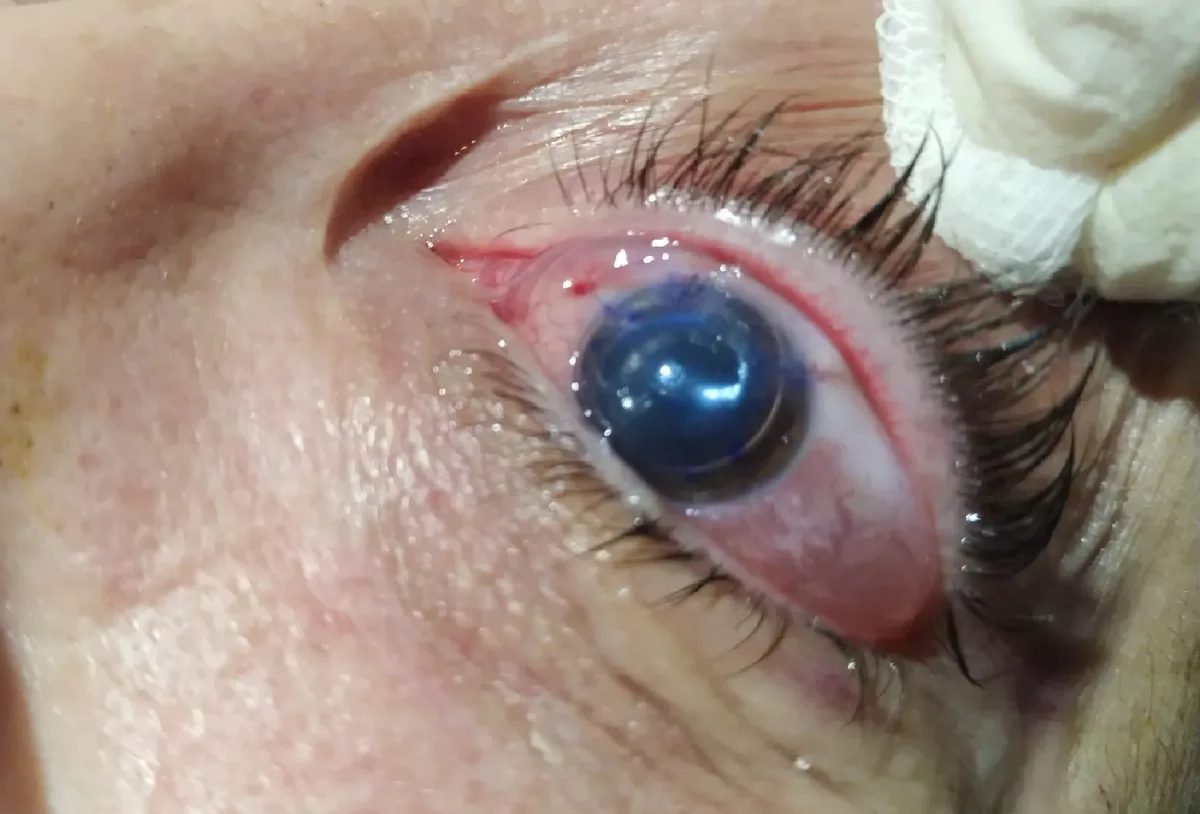 Queratoplastia lamelar endotelial (DMEK)