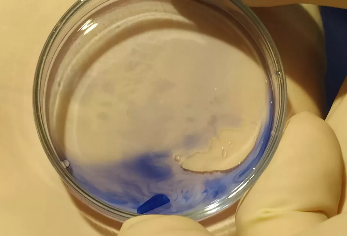 Queratoplastia lamelar endotelial (DMEK)