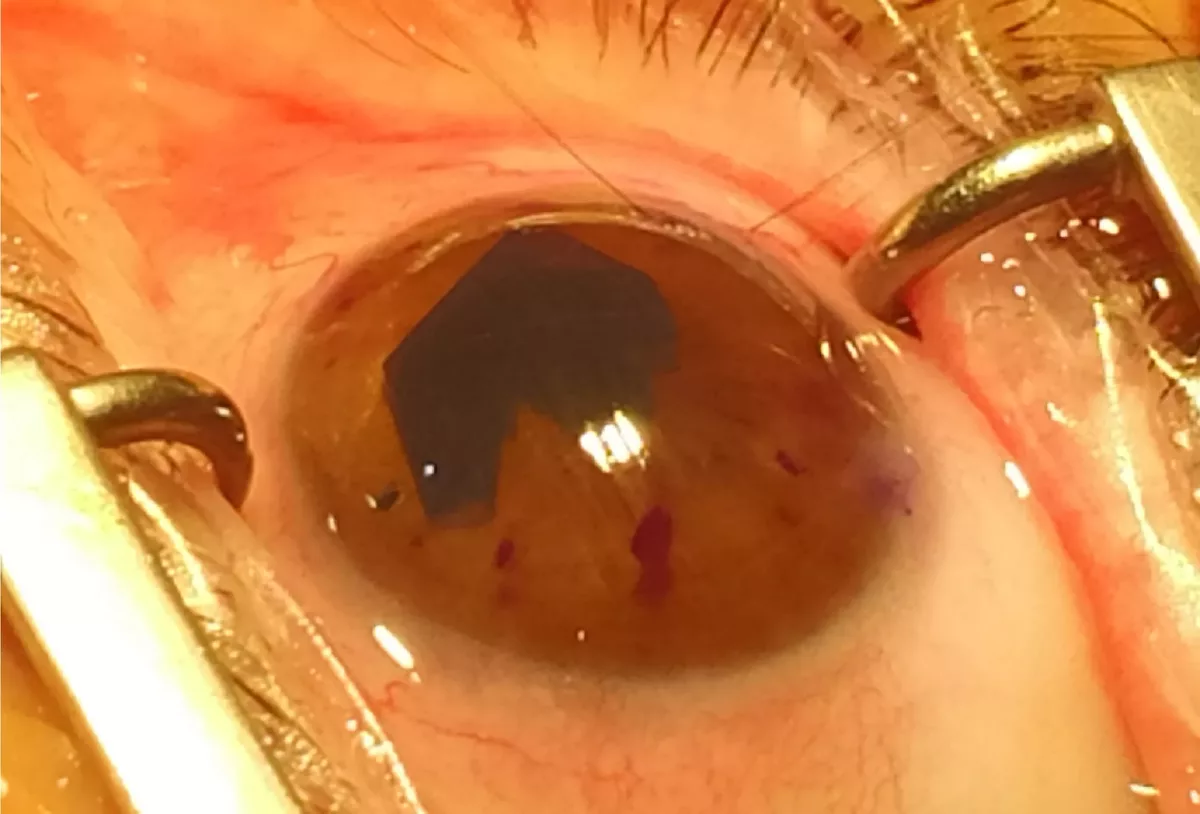 Queratoplastia lamelar endotelial (DMEK)