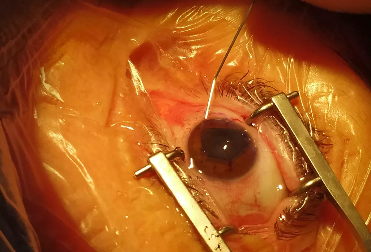 Queratoplastia lamelar endotelial (DMEK)